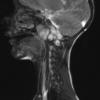 3A1 Chordoma (Case 3) T2 3 - Copy