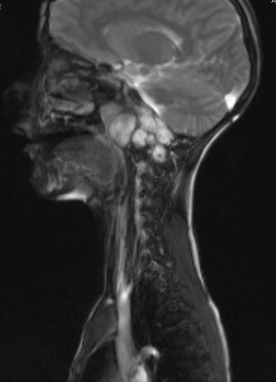 3A1 Chordoma (Case 3) T2 3 - Copy