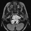 3A2 Chordoma (Case 3) T2 1 - Copy