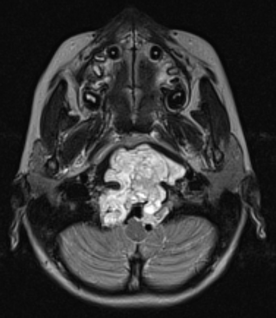 3A2 Chordoma (Case 3) T2 1 - Copy