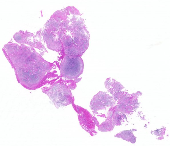 3B1 Chordoma (Case 3) H&E whole mount