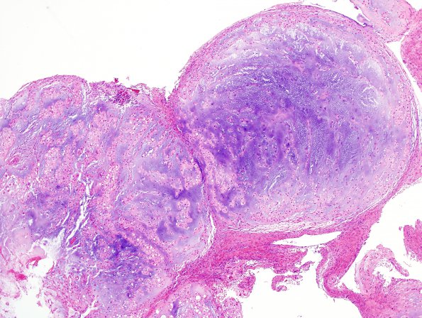  3B2 Chordoma (Case 3) H&E 1.jpg