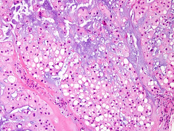 3B3 Chordoma (Case 3) H&E 6.jpg