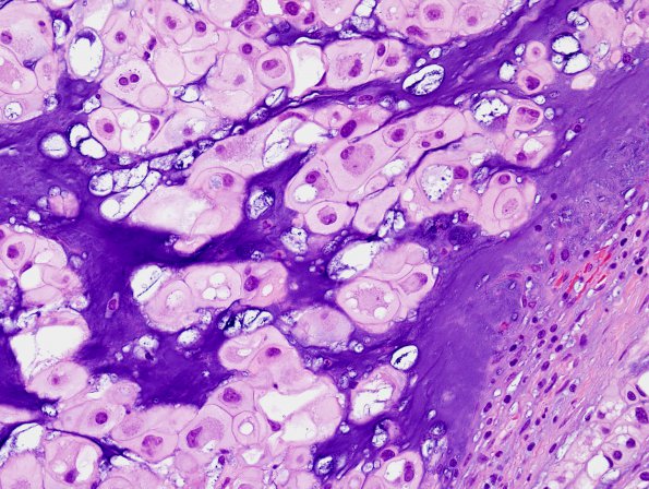 3B5 Chordoma (Case 3) H&E 4.jpg