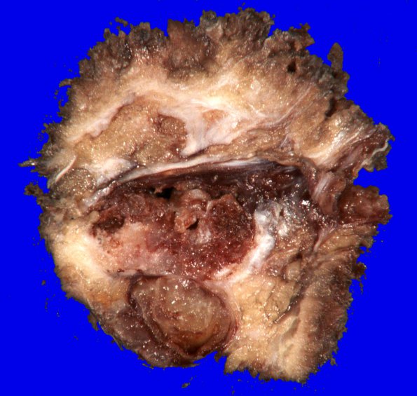 4A1 Chordoma, sacral (Case 4)_2