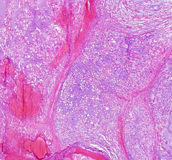 4B1 Chordoma, sacral (Case 4) H&E 8.jpg