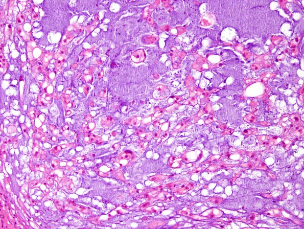 4B2 Chordoma, sacral (Case 4) H&E 3.jpg