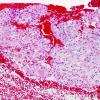 5A1 Chordoma (Case 5) H&E 4