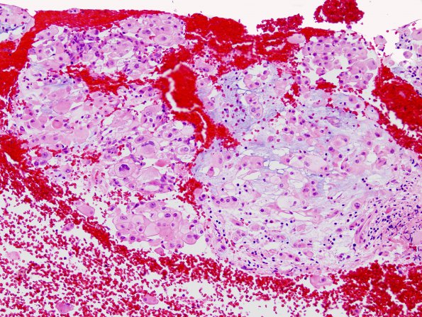 5A1 Chordoma (Case 5) H&E 4