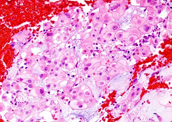 5A2 Chordoma (Case 5) H&E 5