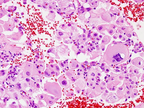 5A3 Chordoma (Case 5) H&E 2