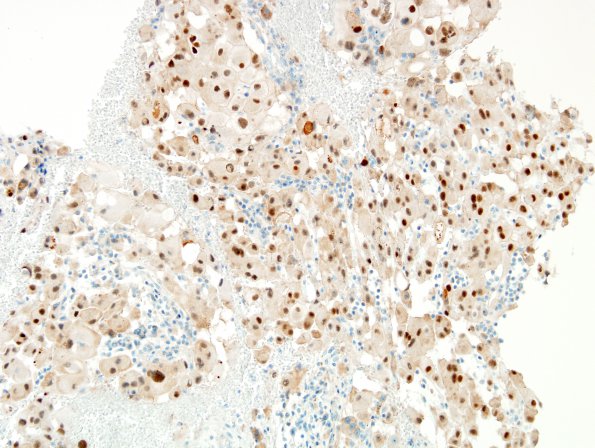 5B1 Chordoma (Case 5) Brachyury 3