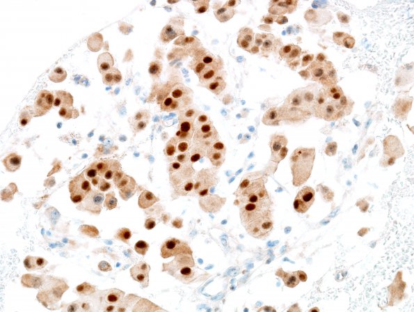 5B2 Chordoma (Case 5) Brachyury 2