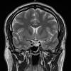 6A Chordoma (Case 6) T2 W 2 - Copy