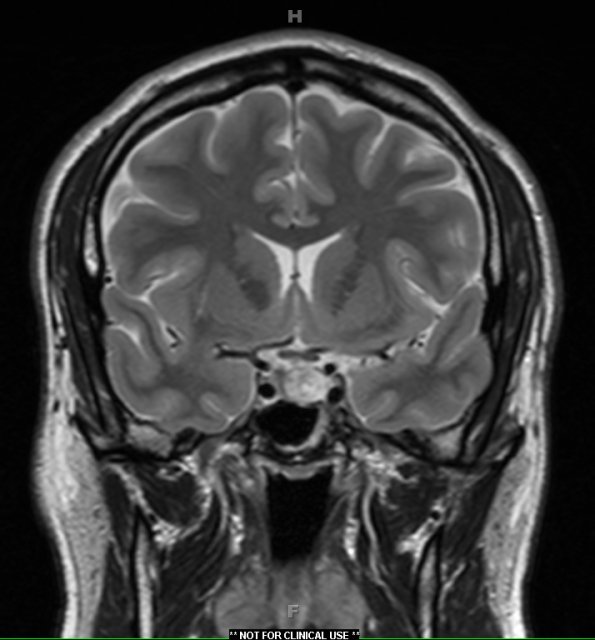 6A Chordoma (Case 6) T2 W 2 - Copy