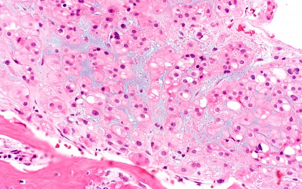 6B2 Chordoma (Case 6) H&E 8