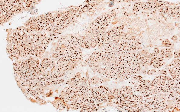 6C Chordoma (Case 6) brachyury 3