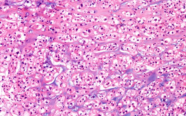 7A2 Chordoma (Case 7) H&E 2