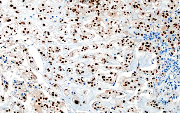 7B2 Chordoma (Case 7) Brachyury 1