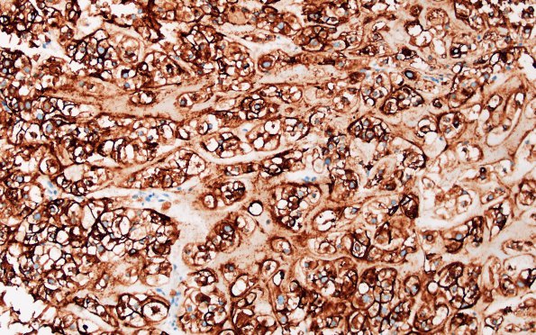 7D Chordoma (Case 7) EMA 1