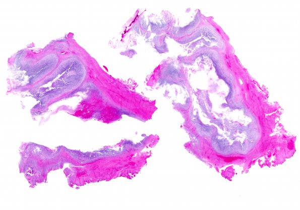 8A1 Chordoma (Case 8) H&E 1