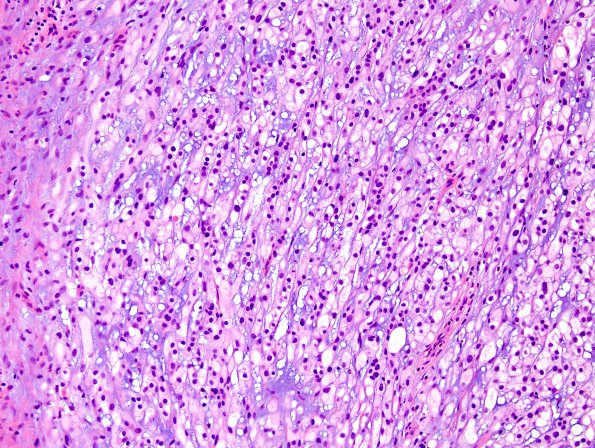 8A2 Chordoma (Case 8) H&E 4