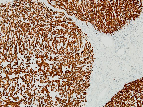 8C Chordoma (Case 8) CK 6