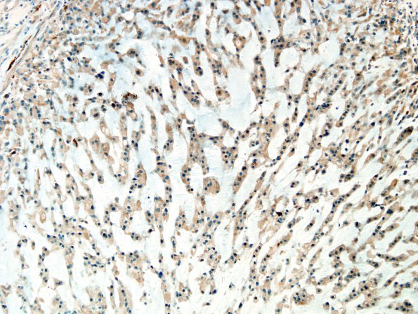 8D Chordoma (Case 8) S100 1