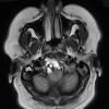 9A Chordoma (Case 9) T2 W 1 - Copy