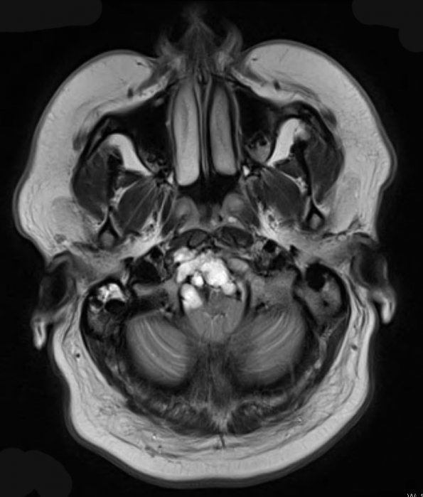 9A Chordoma (Case 9) T2 W 1 - Copy