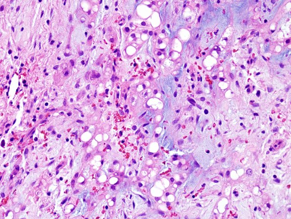 9B Chordoma (Case 9) H&E 4