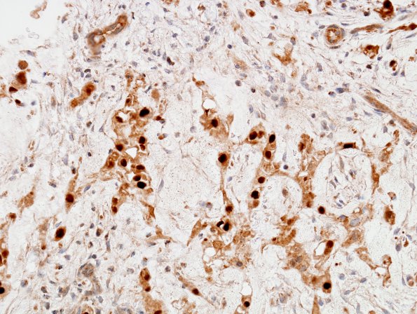 9C Chordoma (Case 9) brachyury 4