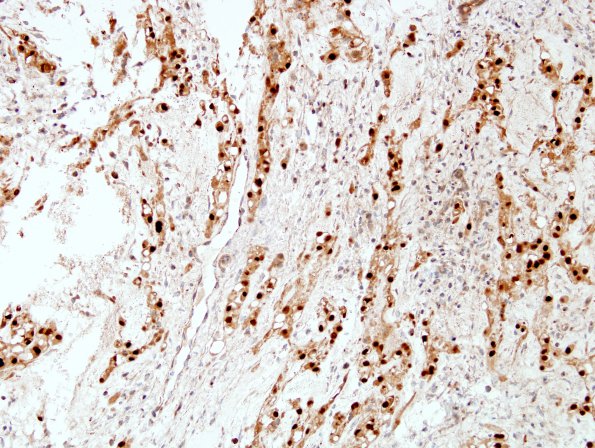 9C1 Chordoma (Case 9) brachyury 3