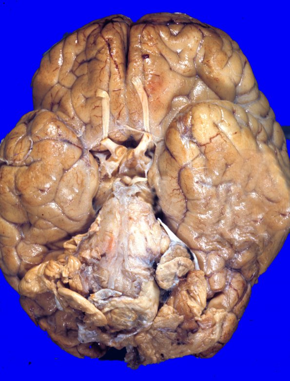 10A1 Hemangioblastoma (VHL Case 10) a