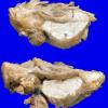 10A2 Hemangioblastoma (VHL Case 10) b