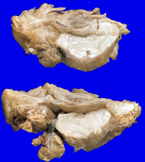 10A2 Hemangioblastoma (VHL Case 10) b