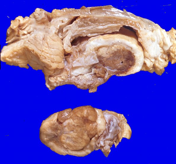 10A3 Hemangioblastomas (VHL Case 10) c