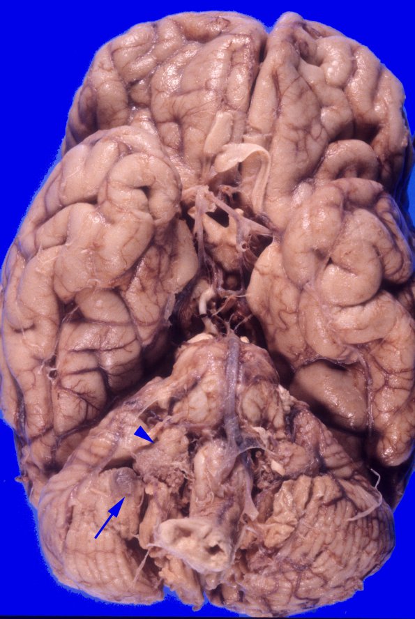 12A1 Hemangioblastoma  (Case 12) copy