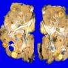 13 Metastases (Case 13) Renal (Von Hippel Lindau)