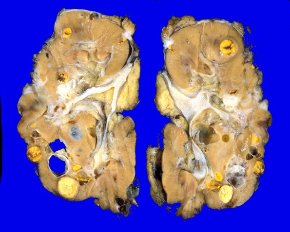 13 Metastases (Case 13) Renal (Von Hippel Lindau)