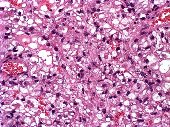 14A Metastases Renal (Case 14)