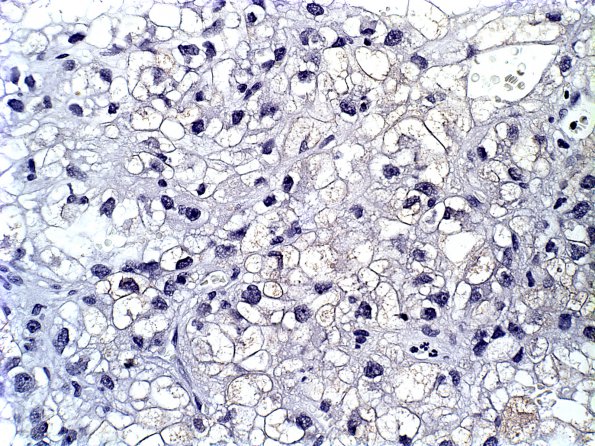 14B Metastases Renal (Case 14) S-100