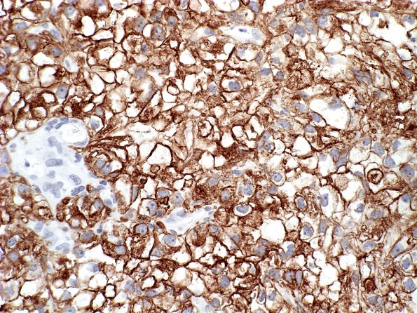 14C1 Metastases Renal (Case 14) CK