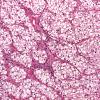 15A Metastases Renal (Case 15)