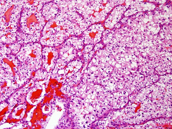 16A Metastases, renal ((Case 16) H&E 1.jpg