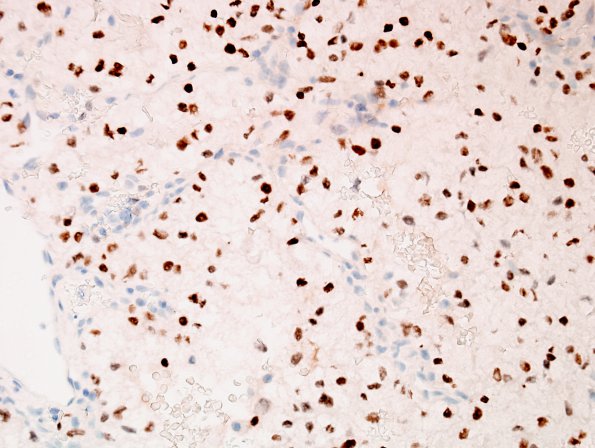 16B1 Metastases, renal (Case 16) PAX-8 1.jpg