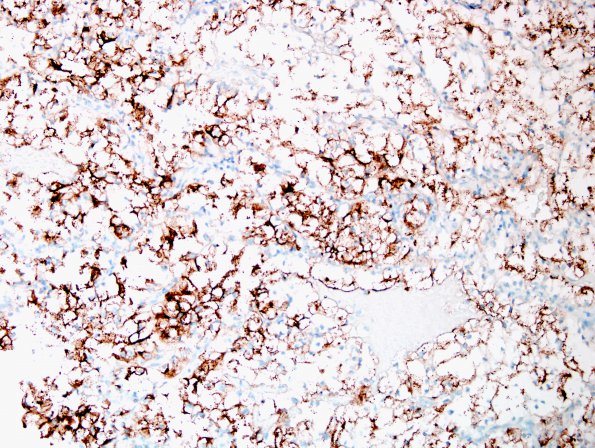 16B2 Metastases, renal (Case 16) RCC.jpg