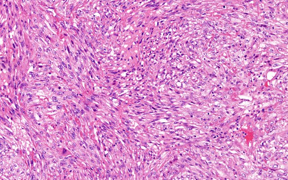 17A1 Metastases, renal (Case 17) H&E 2