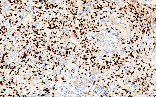 17B Metastases, renal (Case 17) PAX-8