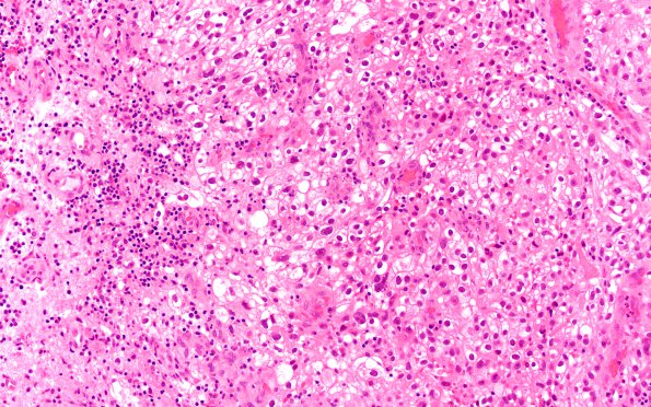 18A1 Metastasis, renal (Case 18) H&E 1